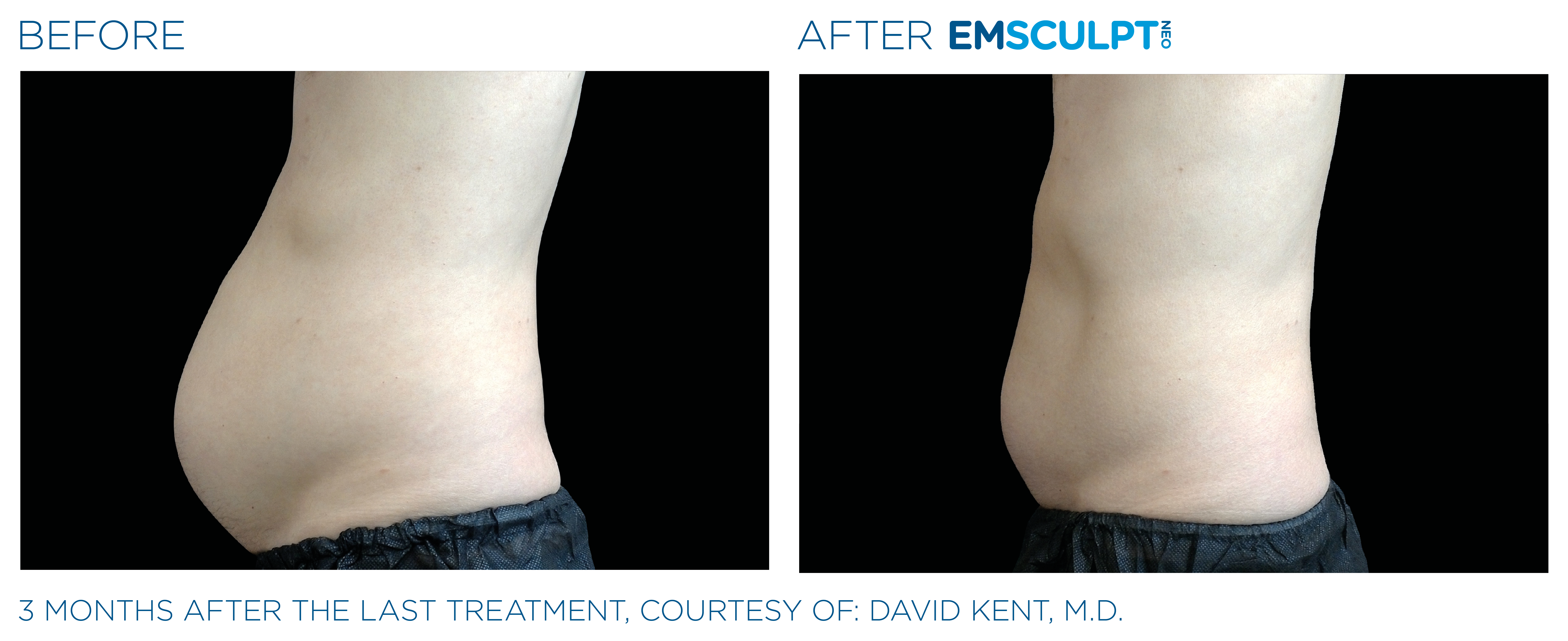 MALE ABDOMEN IMPROVEMENT Before & After