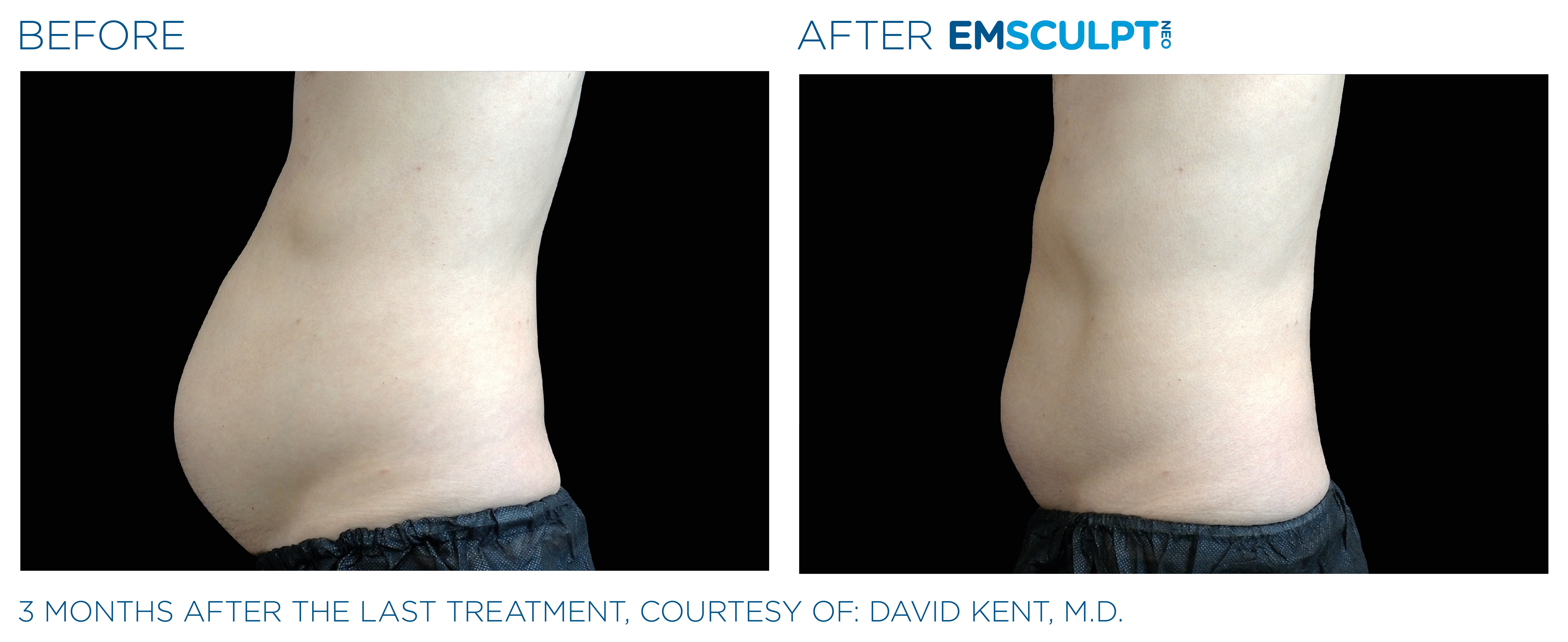 MALE ABDOMEN IMPROVEMENT Before & After