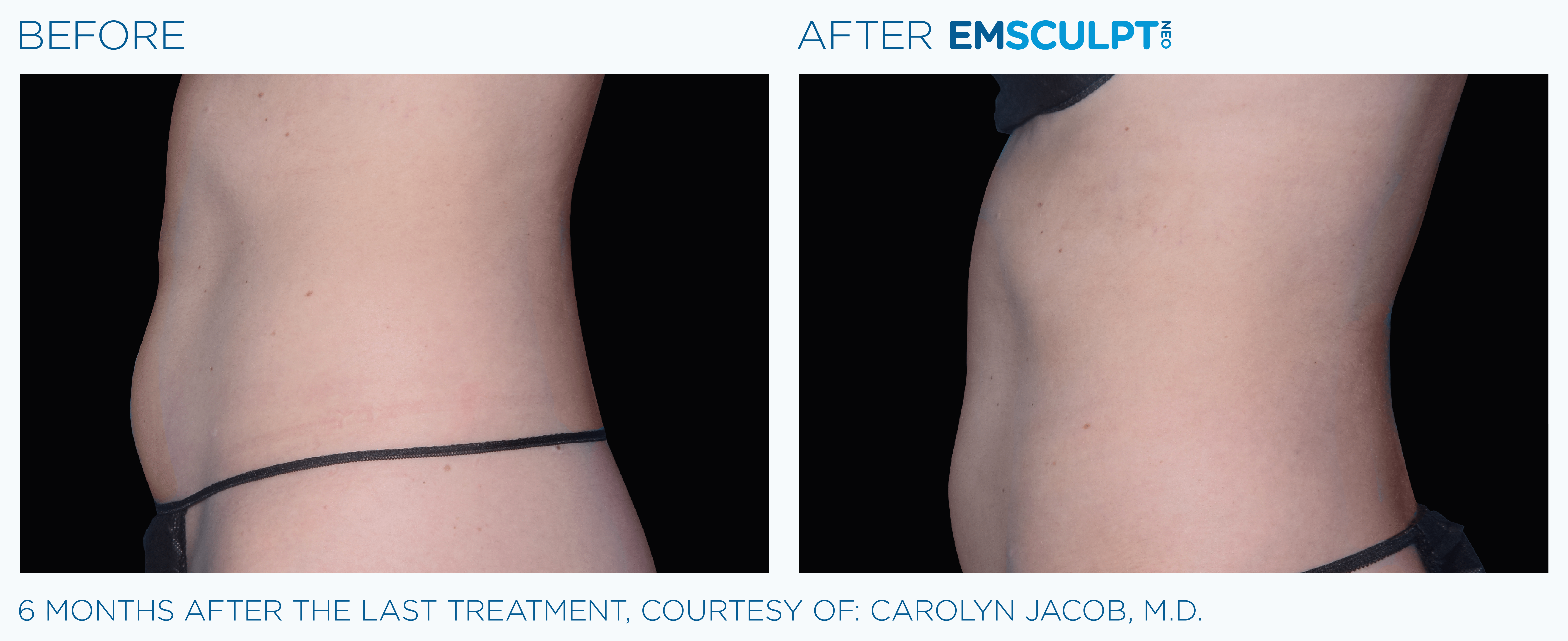 FEMALE ABDOMEN IMPROVEMENT Before & After
