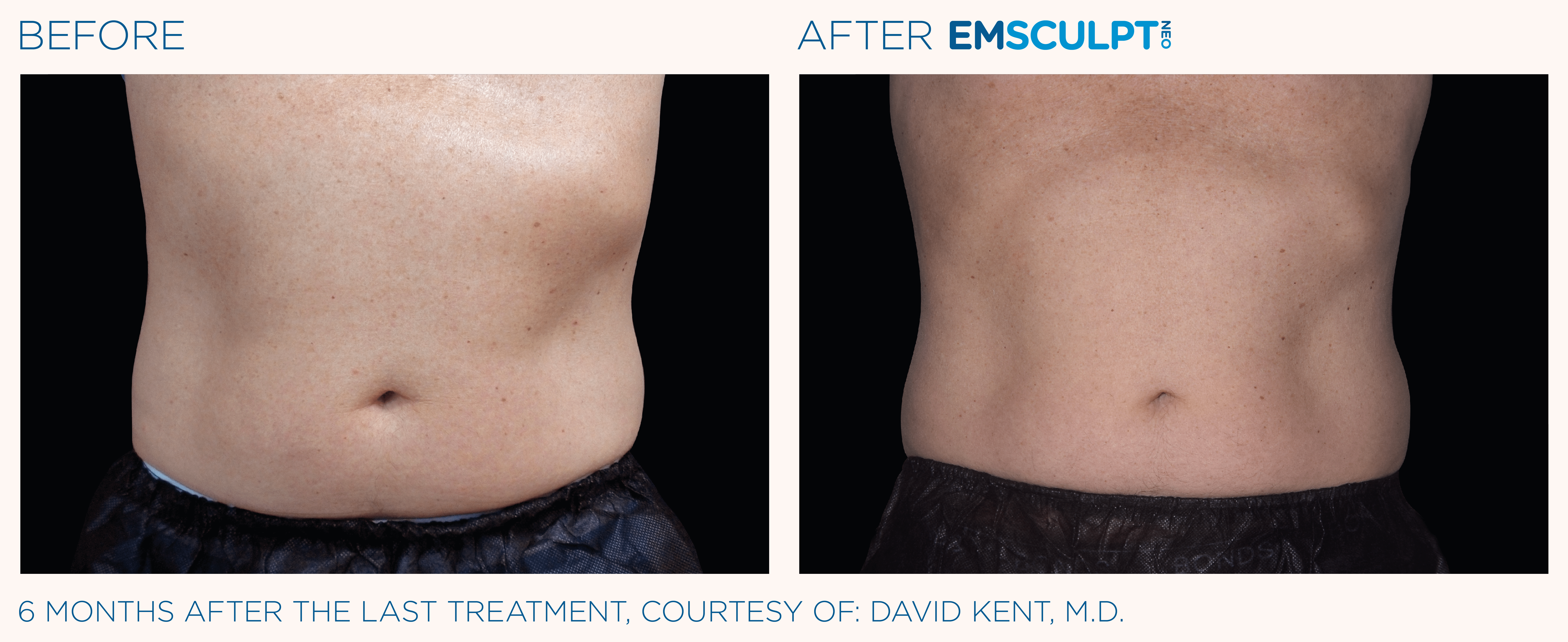 MALE ABDOMEN IMPROVEMENT Before & After