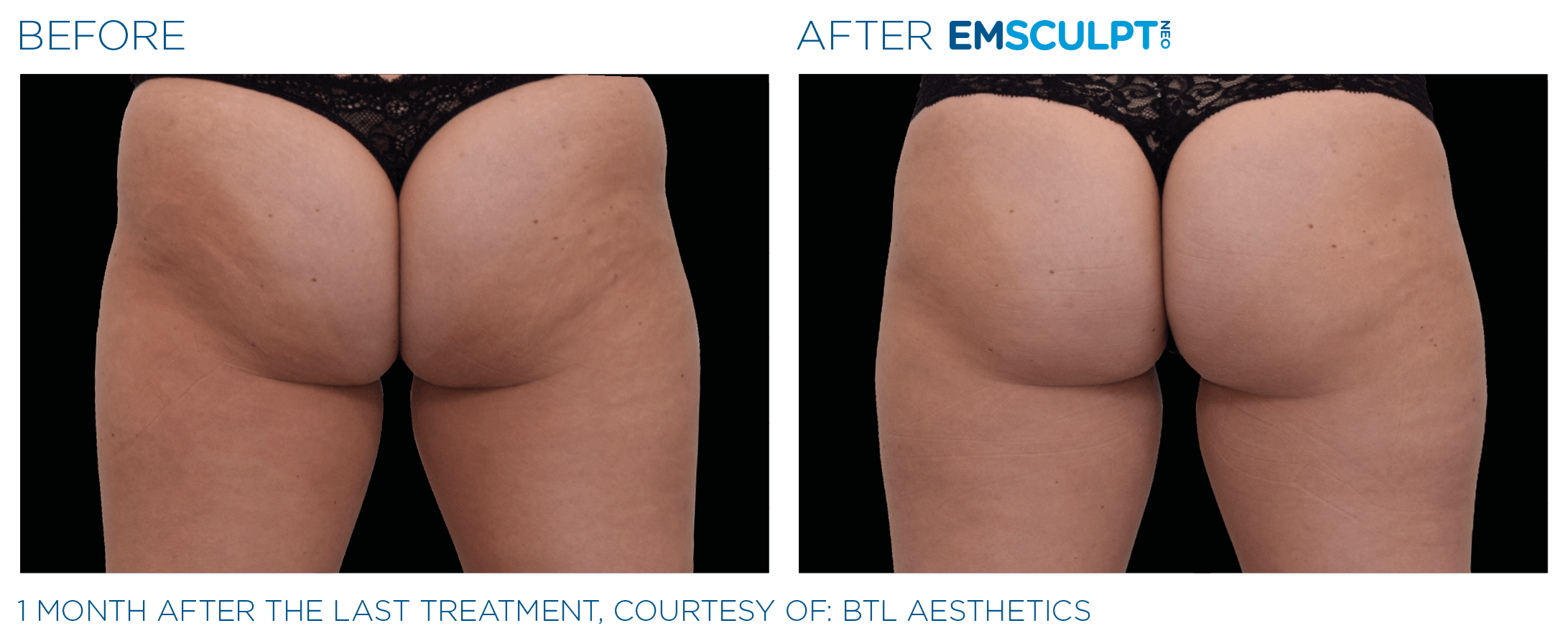 FEMALE BUTTOCKS IMPROVEMENT Before & After