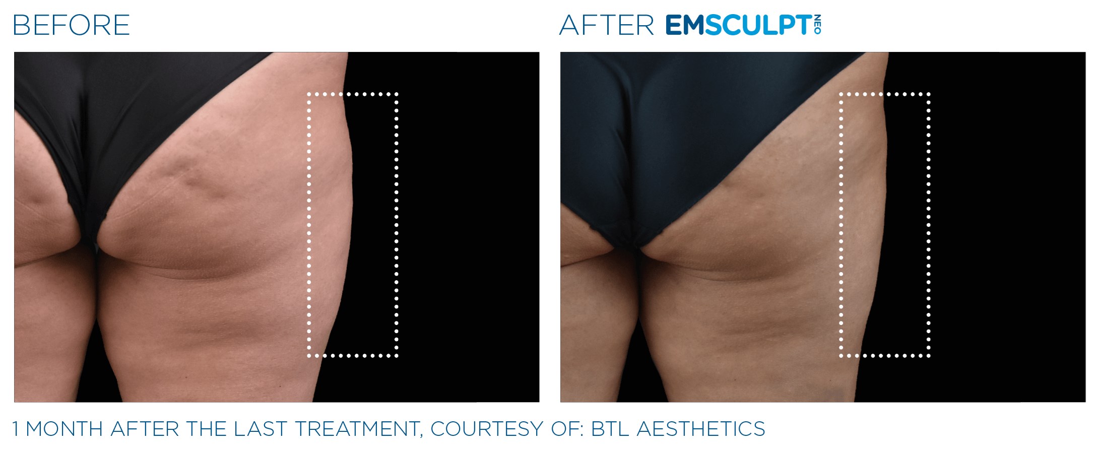 FEMALE OUTER THIGH Before & After
