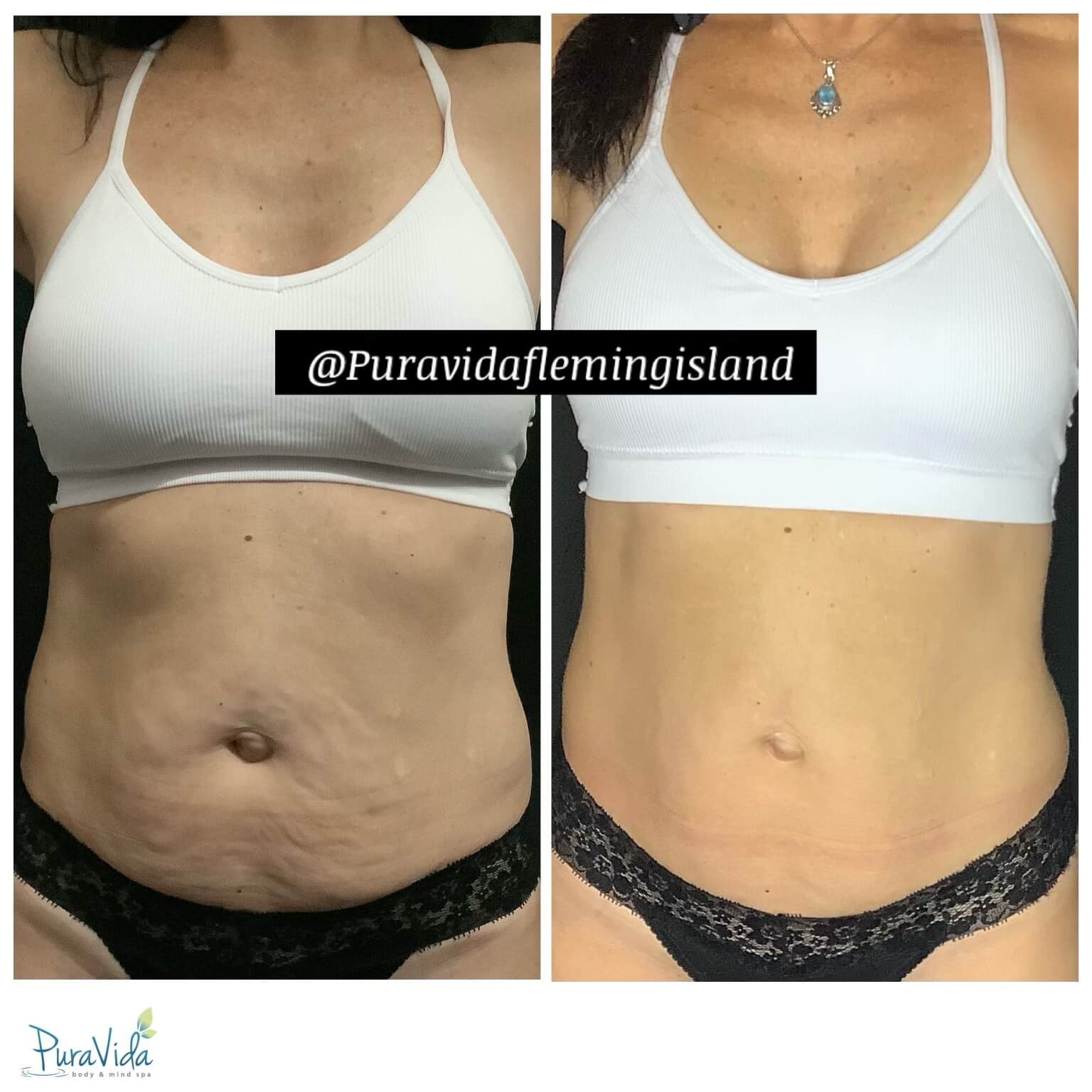 Fat Loss & Body Contouring Before & After