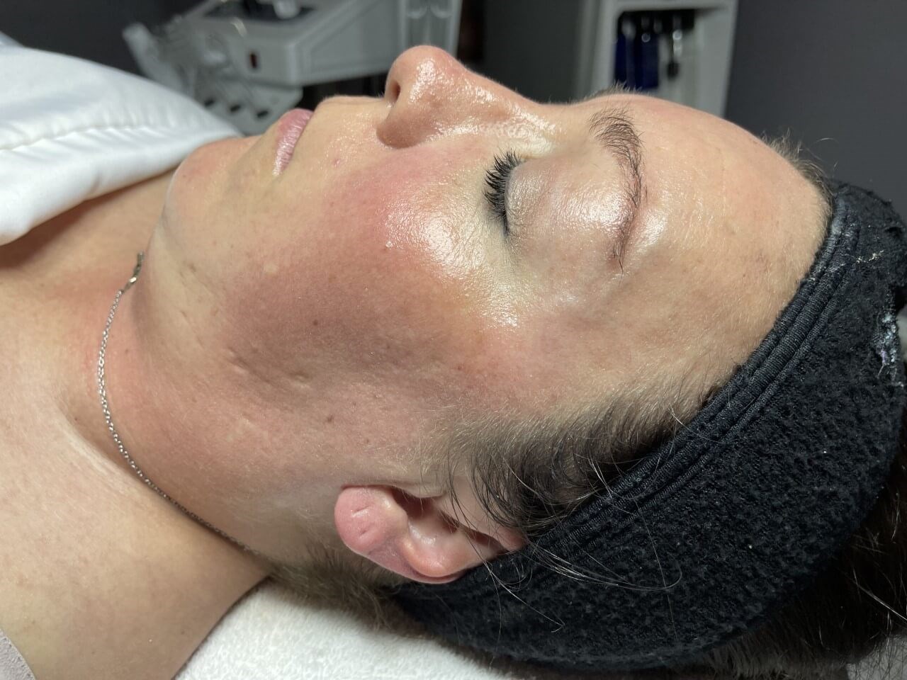 Skin Rejuvenation After