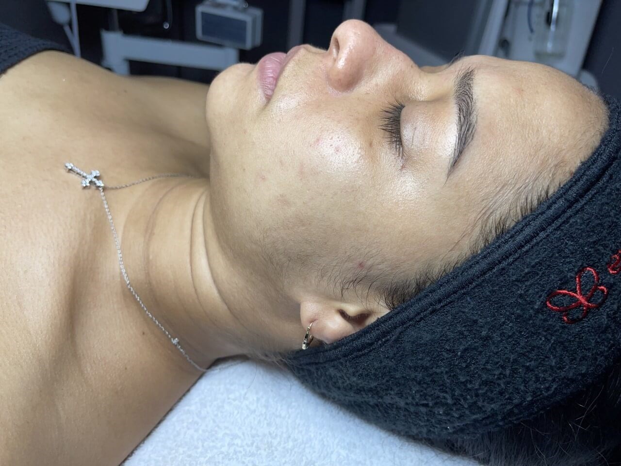 Diamond Glow and Dermaplaning Before