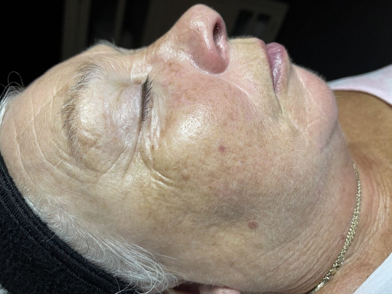 Pure Essential Facial Before
