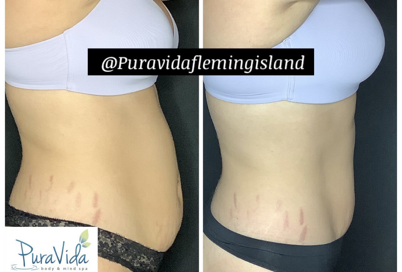 Emsculpt Neo- 4 Sessions 1 month after 4th session