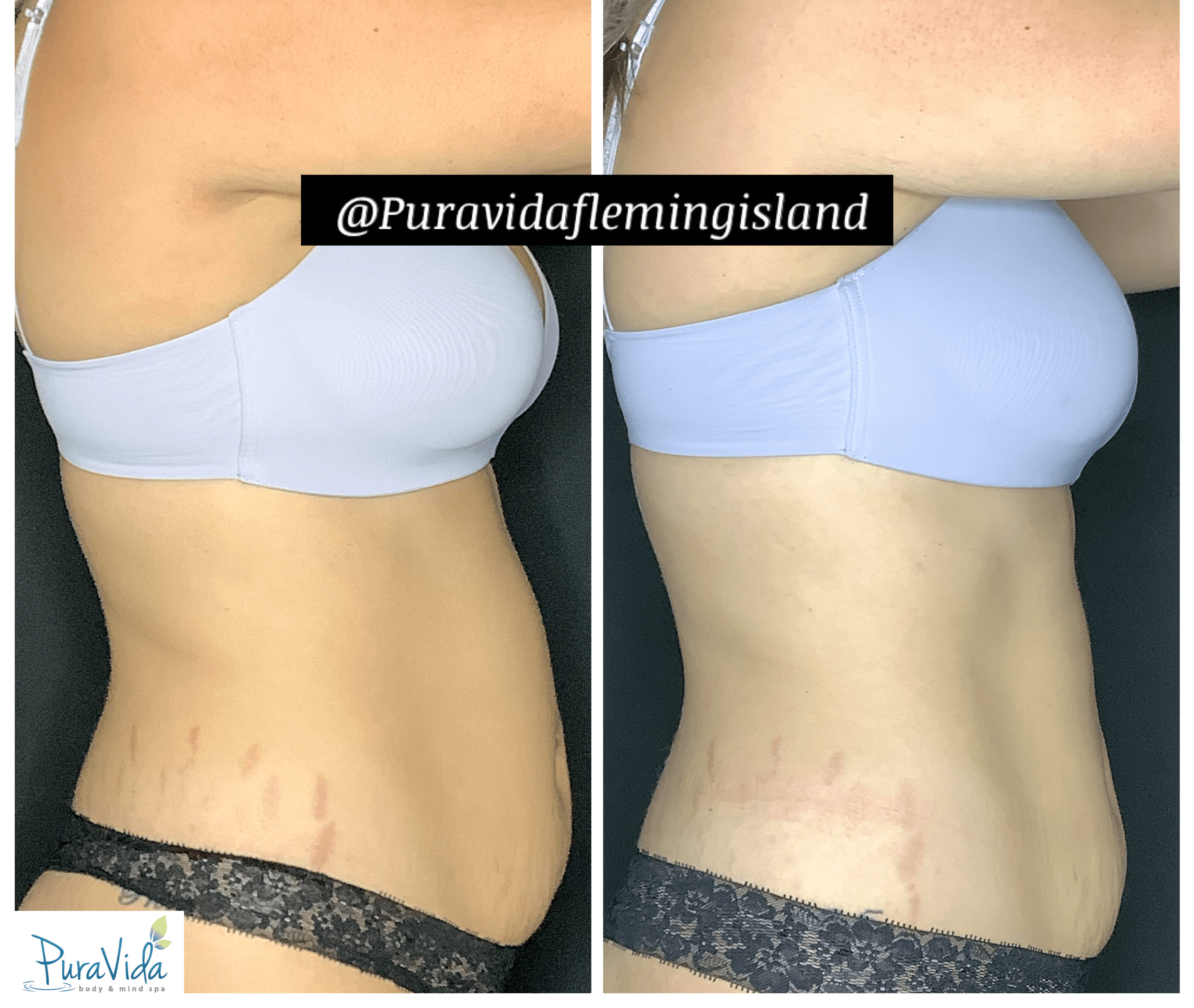 Emsculpt Neo- 4 Sessions Immediately after 4th session