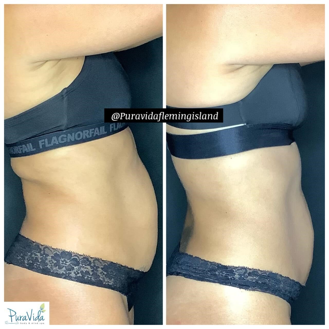 Fat Loss & Body Contouring Before & After 1 month