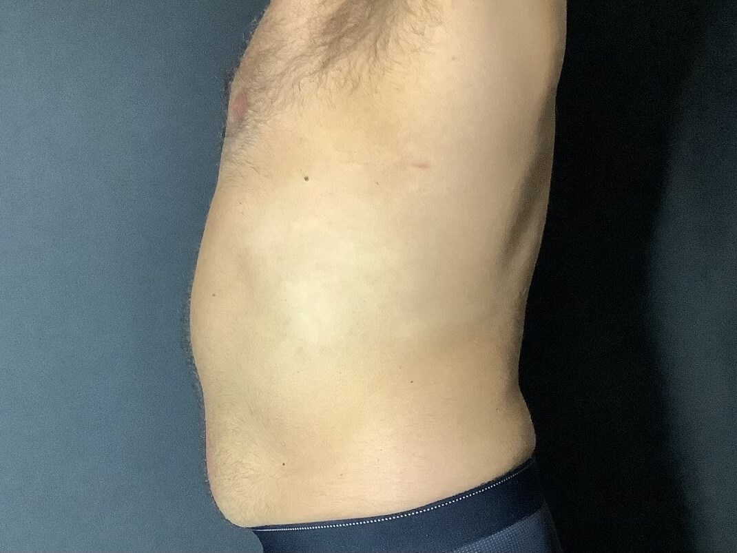 Emsculpt Neo Results on Male After EMSculpt NEO Abs
