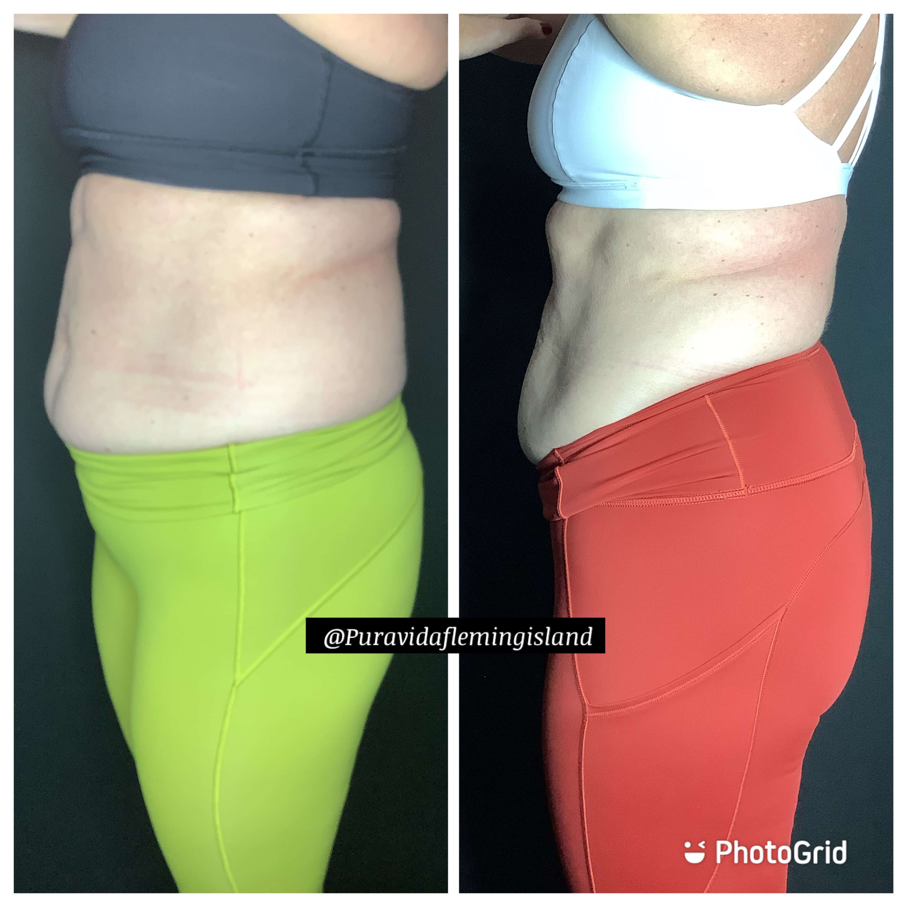 Emsculpt Neo abdominals Before
