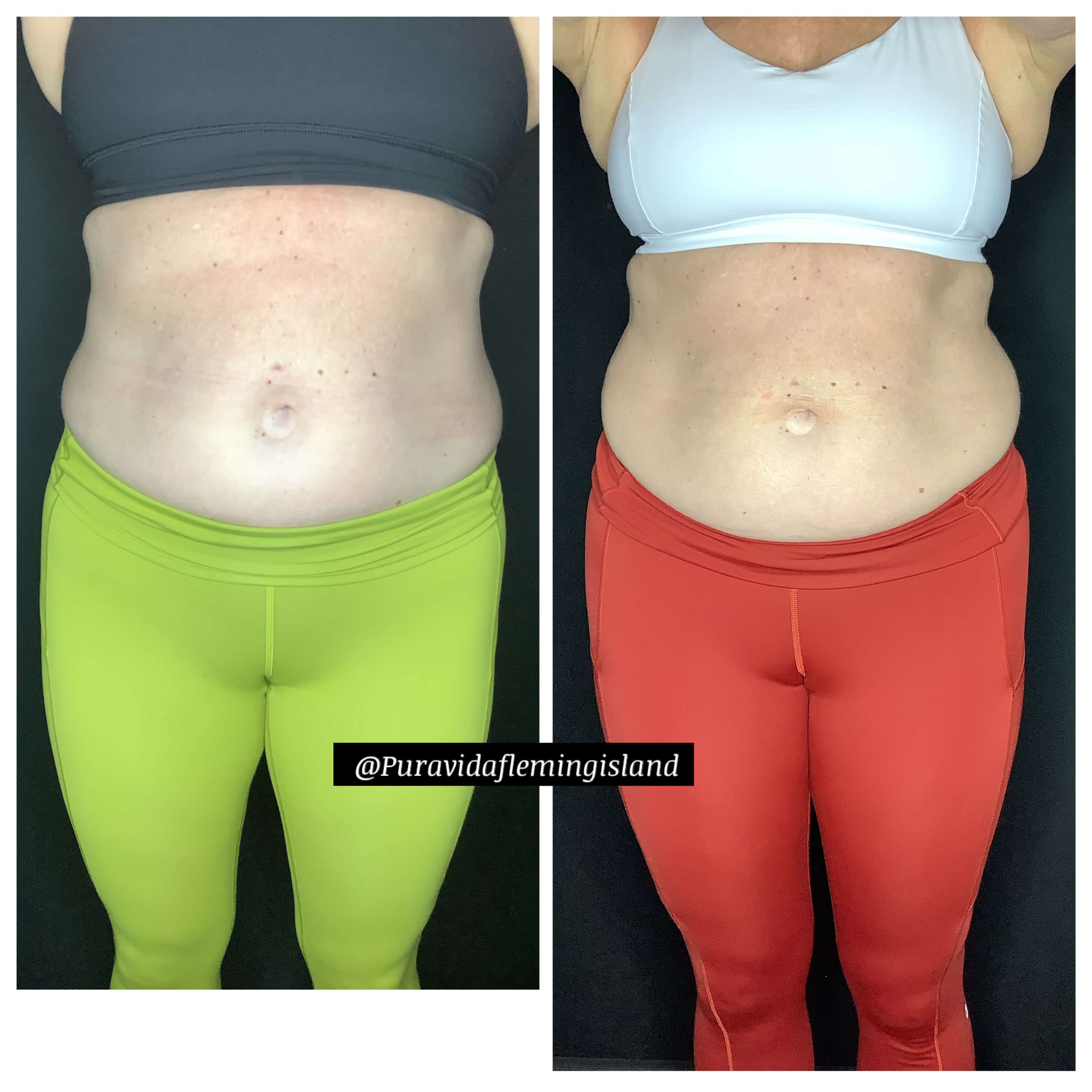 Emsculpt Neo abdominals After