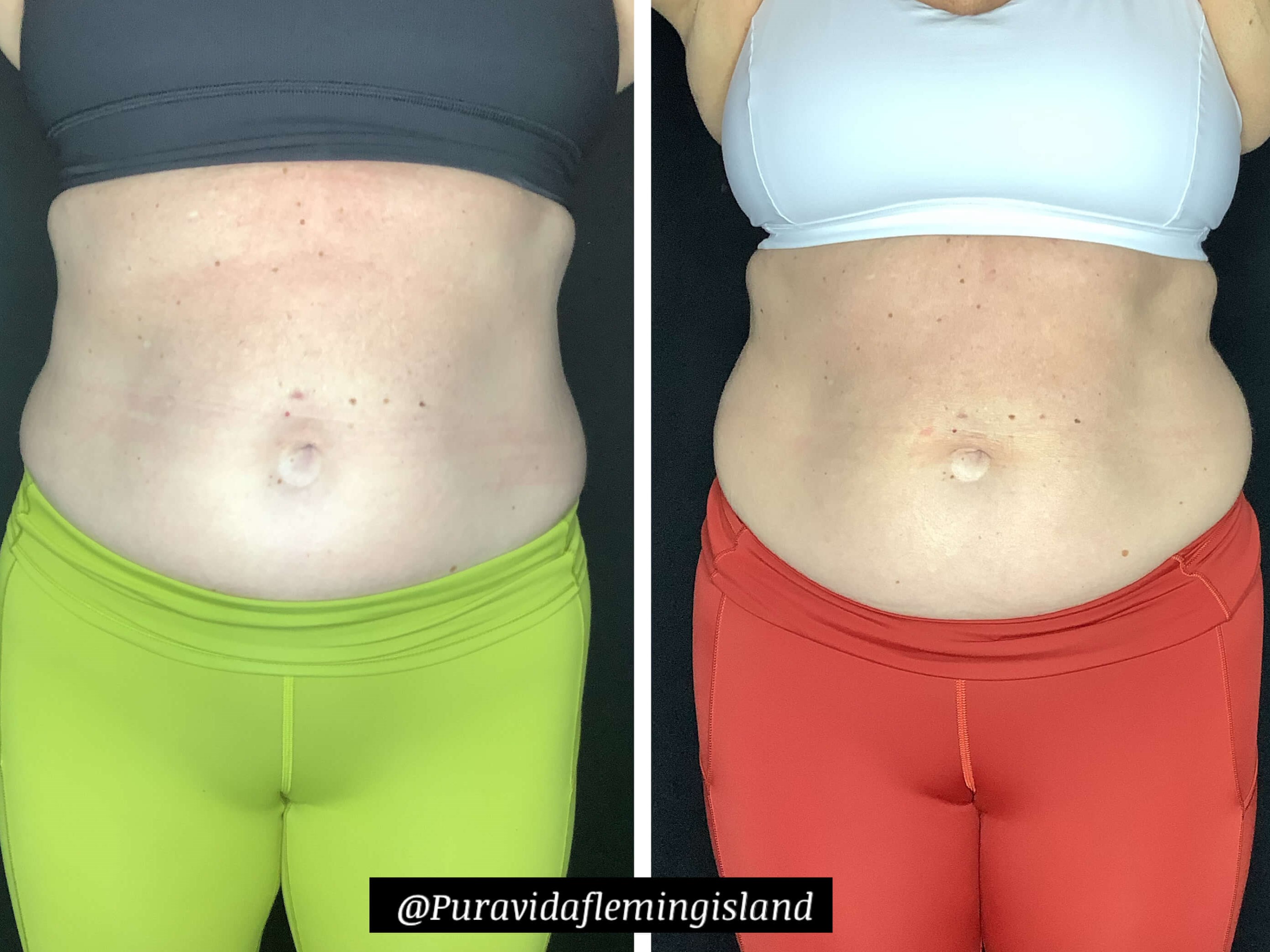 Emsculpt Neo abdominals After