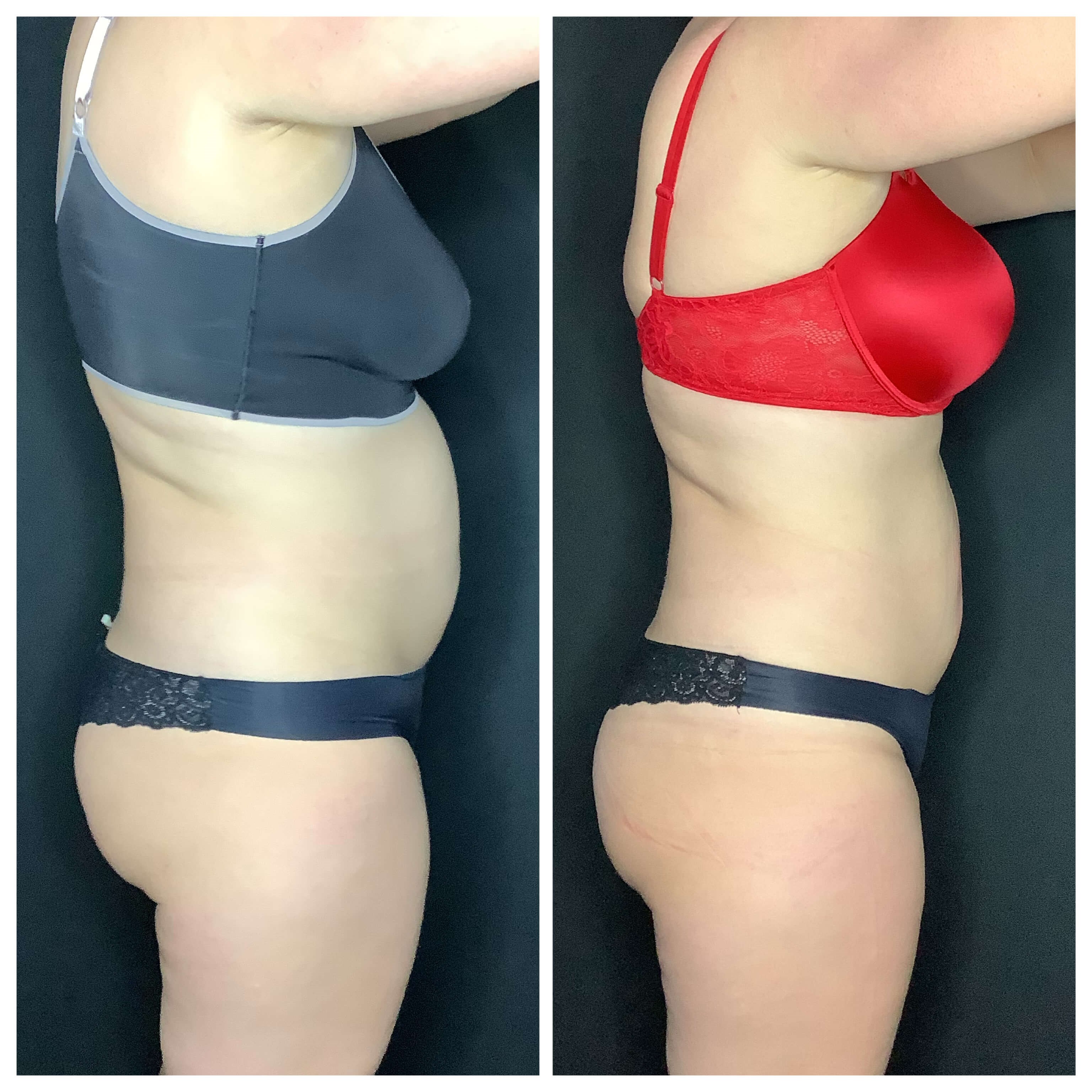 Postpartum tummy strength Before