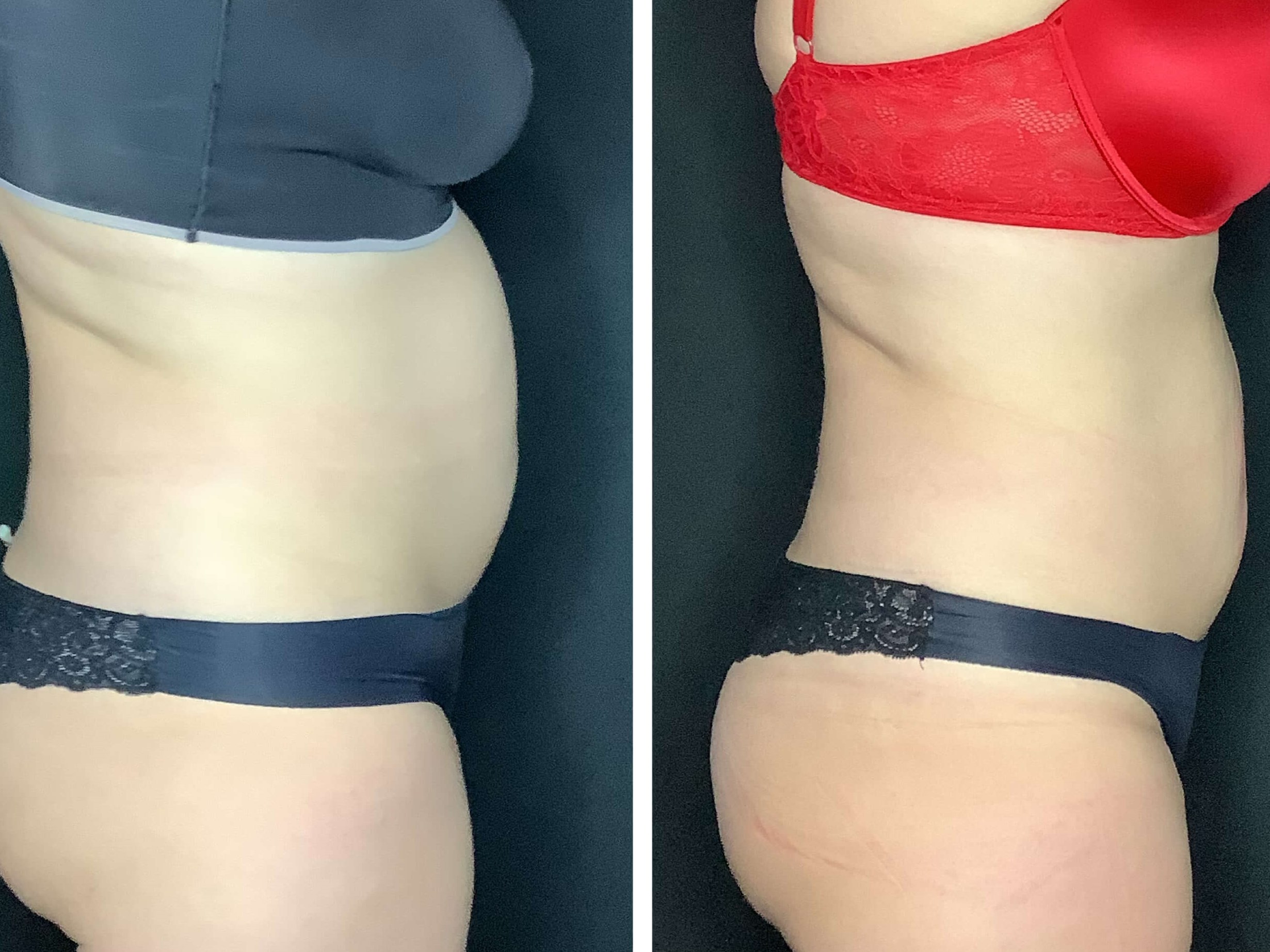 Postpartum tummy strength Before