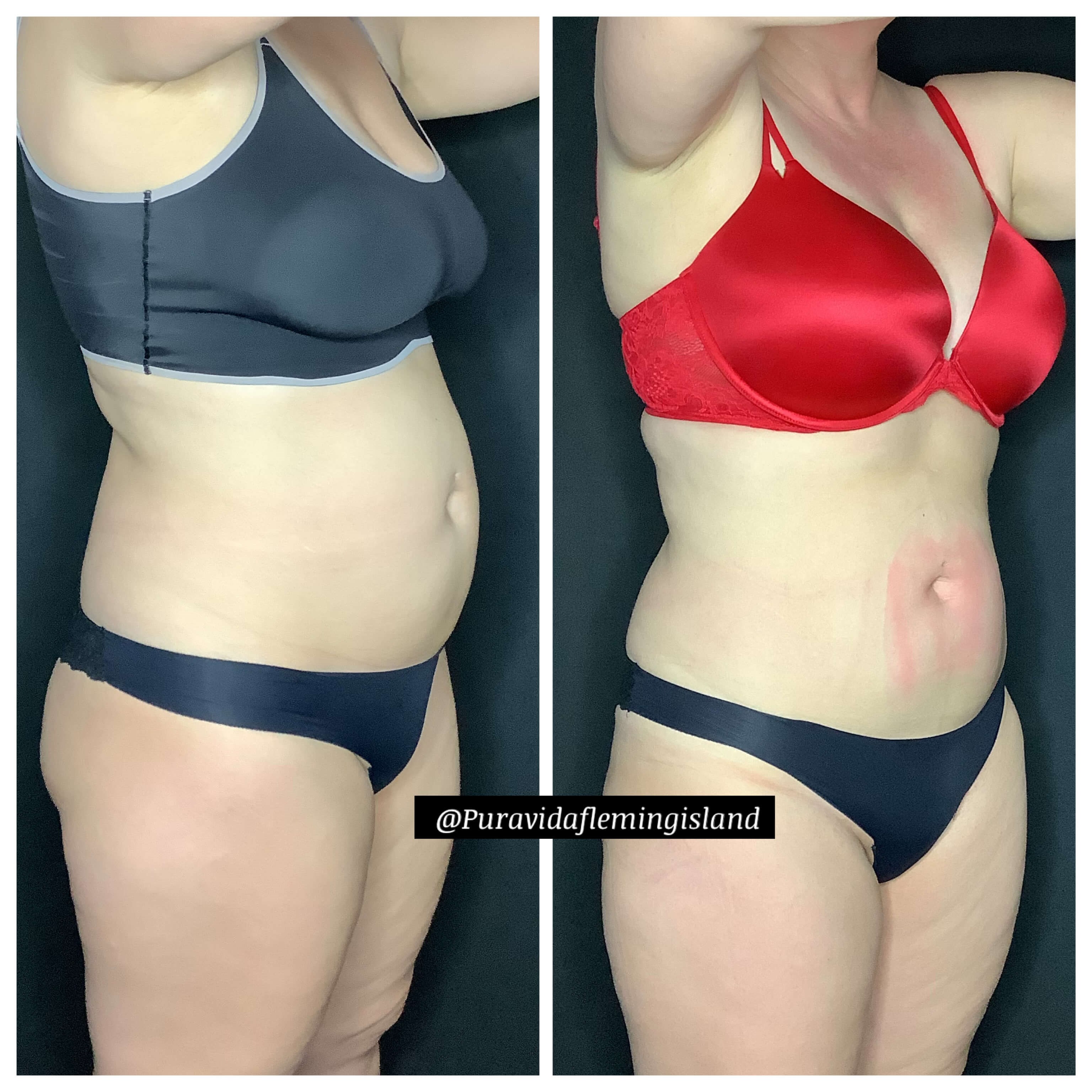 Postpartum tummy strength After