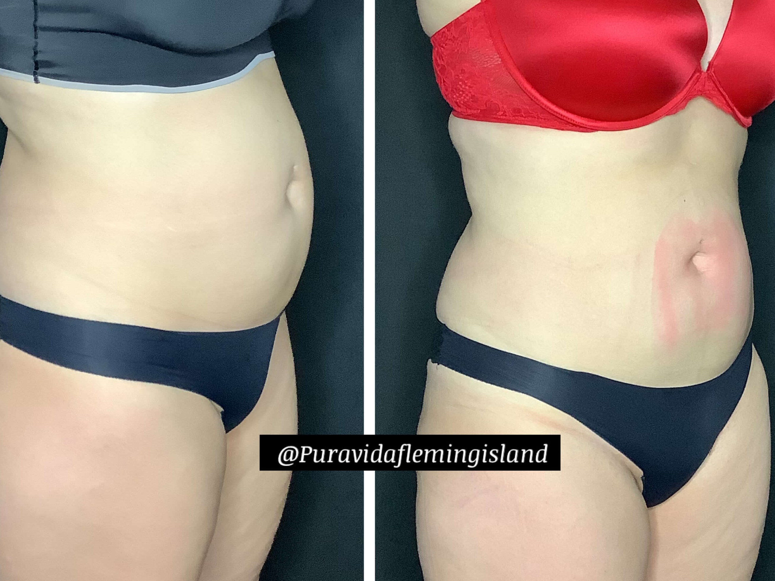 Postpartum tummy strength After