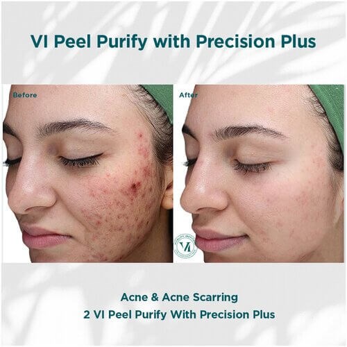 VI Peel Before