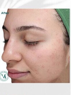 VI Peel After