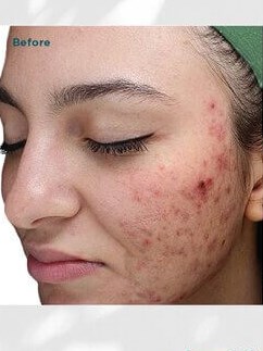 VI Peel Before