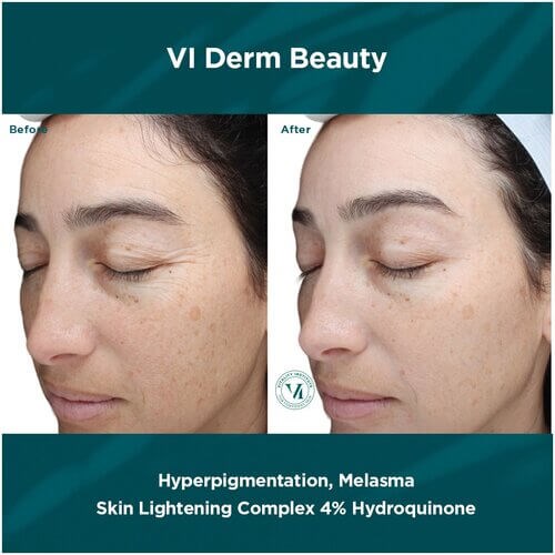 VI Peel Before