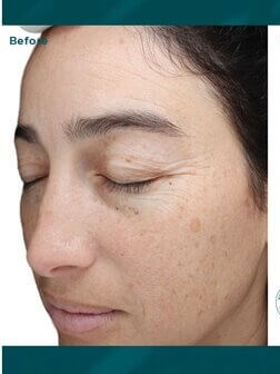 VI Peel Before