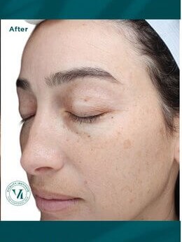 VI Peel After