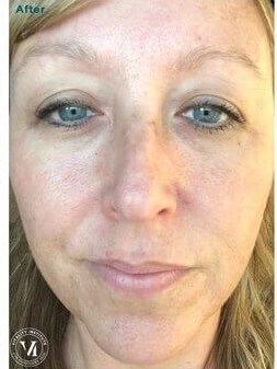 VI Peel After