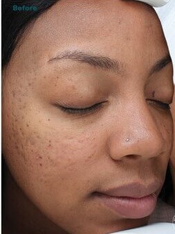 VI Peel Before
