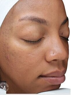 VI Peel After