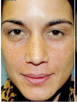 VI Peel Before