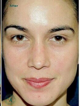 VI Peel After
