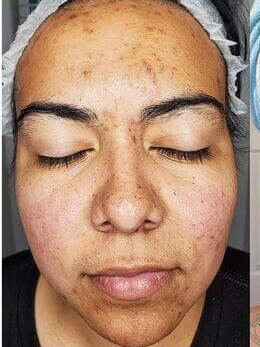VI Peel Before