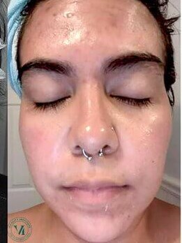 VI Peel After