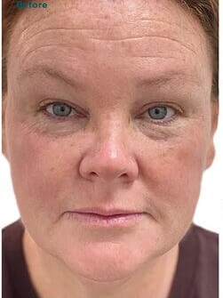 VI Peel Before