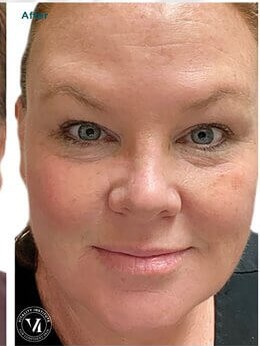 VI Peel After