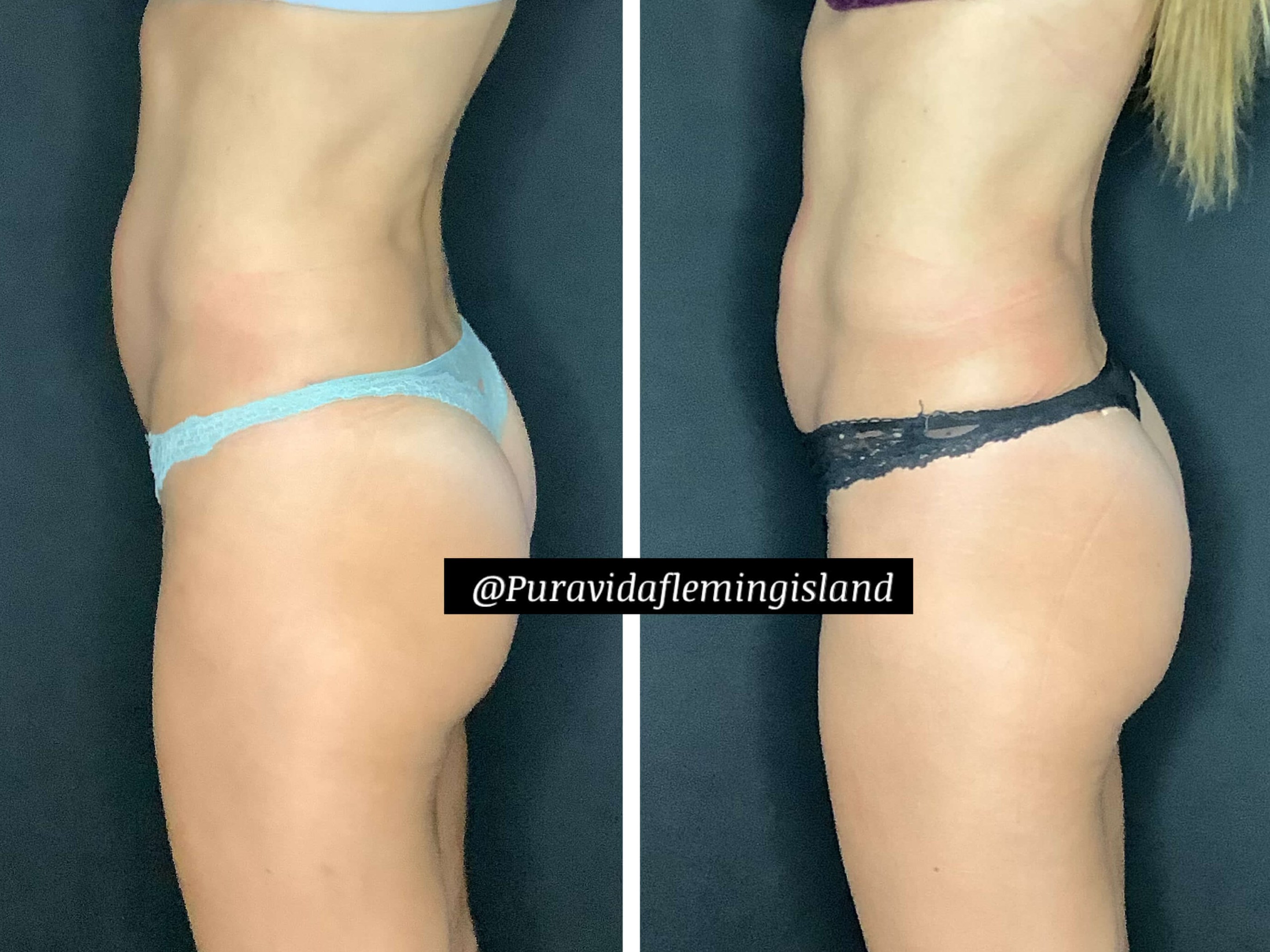 Abdominal and core strength Before