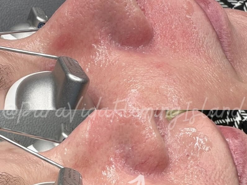 Laser Vein removal on the nose Before