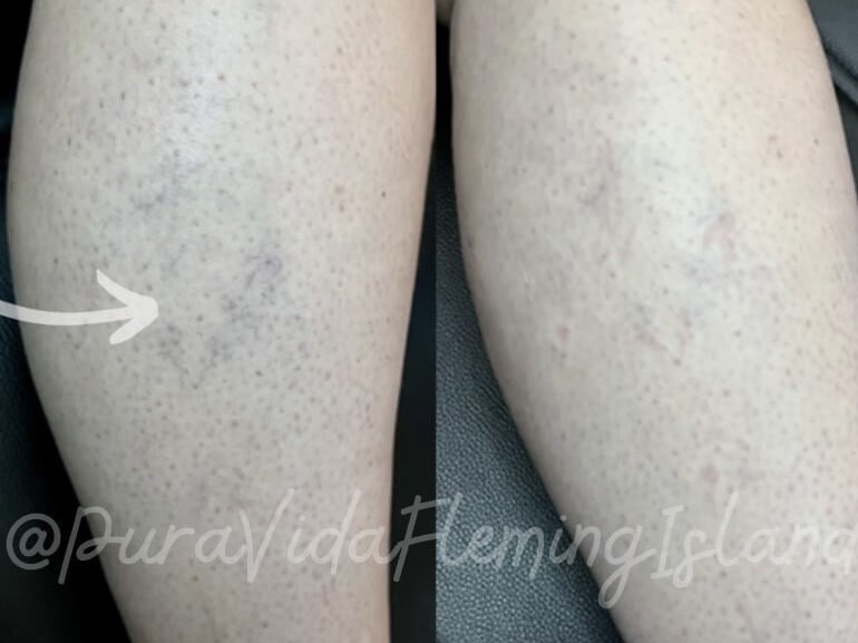 Laser Vein removal on the leg After