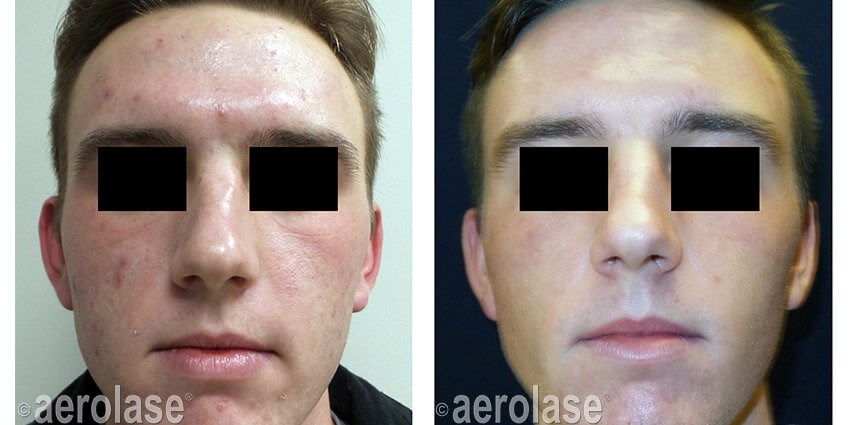 Aerolase Acne Treatment Before
