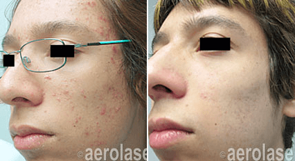 Aerolase Before
