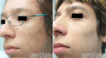 Aerolase Before