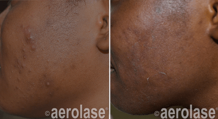 Aerolase Before