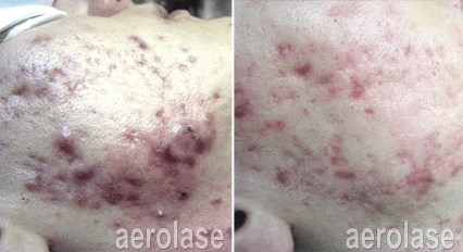 Aerolase Before