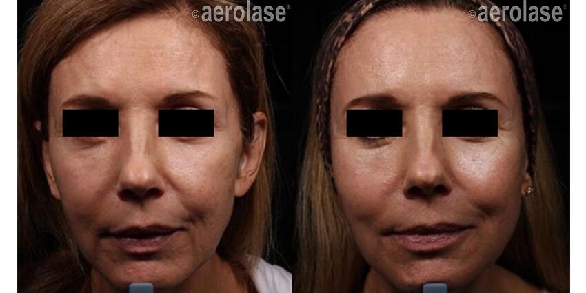 Aerolase Before