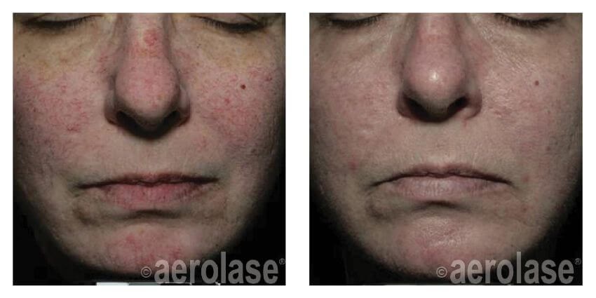 Aerolase Before