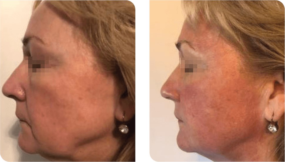 Non Surgical FaceLift Before
