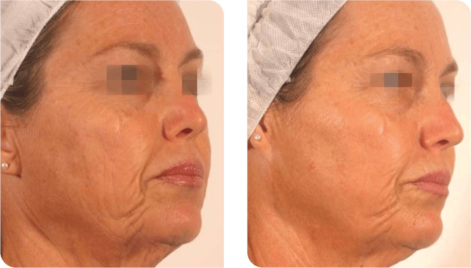 TriLift- NonSurgical FaceLift Before