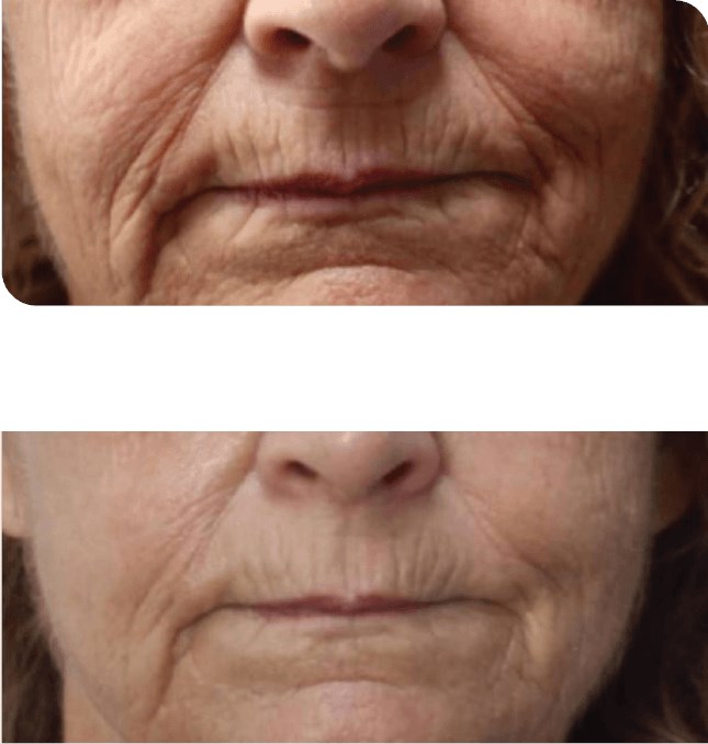 TriLift Treatment Before