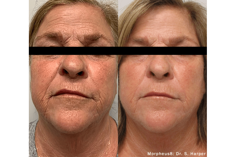 Fine Lines before treatment